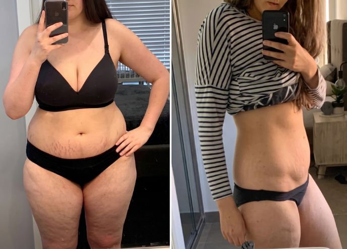 Before and after · waist · stretch marks and crepey skin