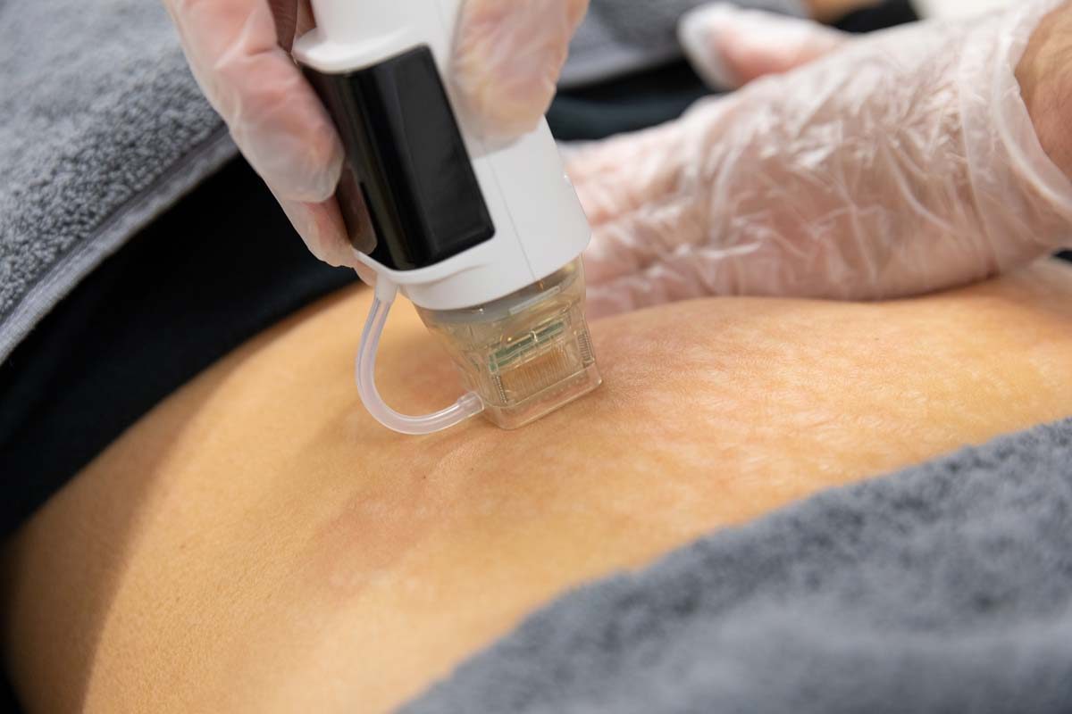 Radiofrequency microneedling performed on a woman's skin in a clinic
