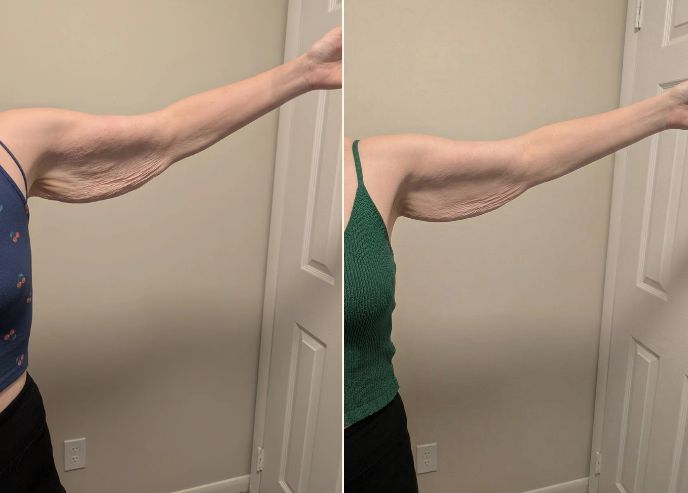 Arms before and after Vesper treatment