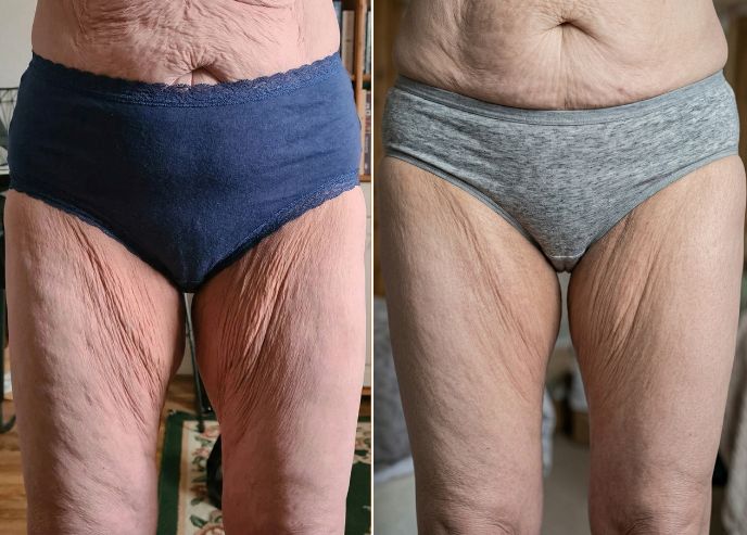 Before and after — Helene K.