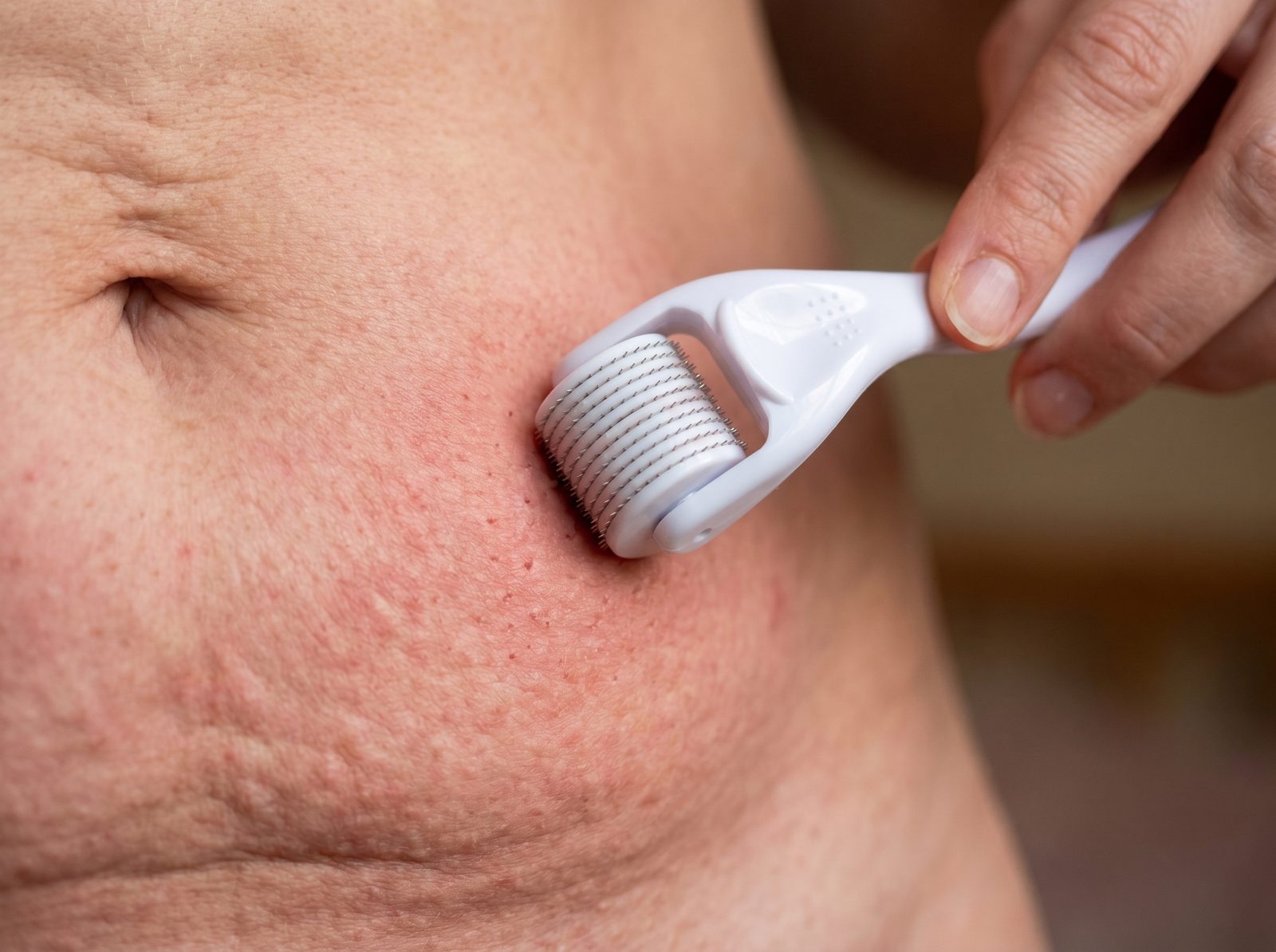 A woman attempting microneedling on her own loose belly skin at home with a dermaroller, skin irritated