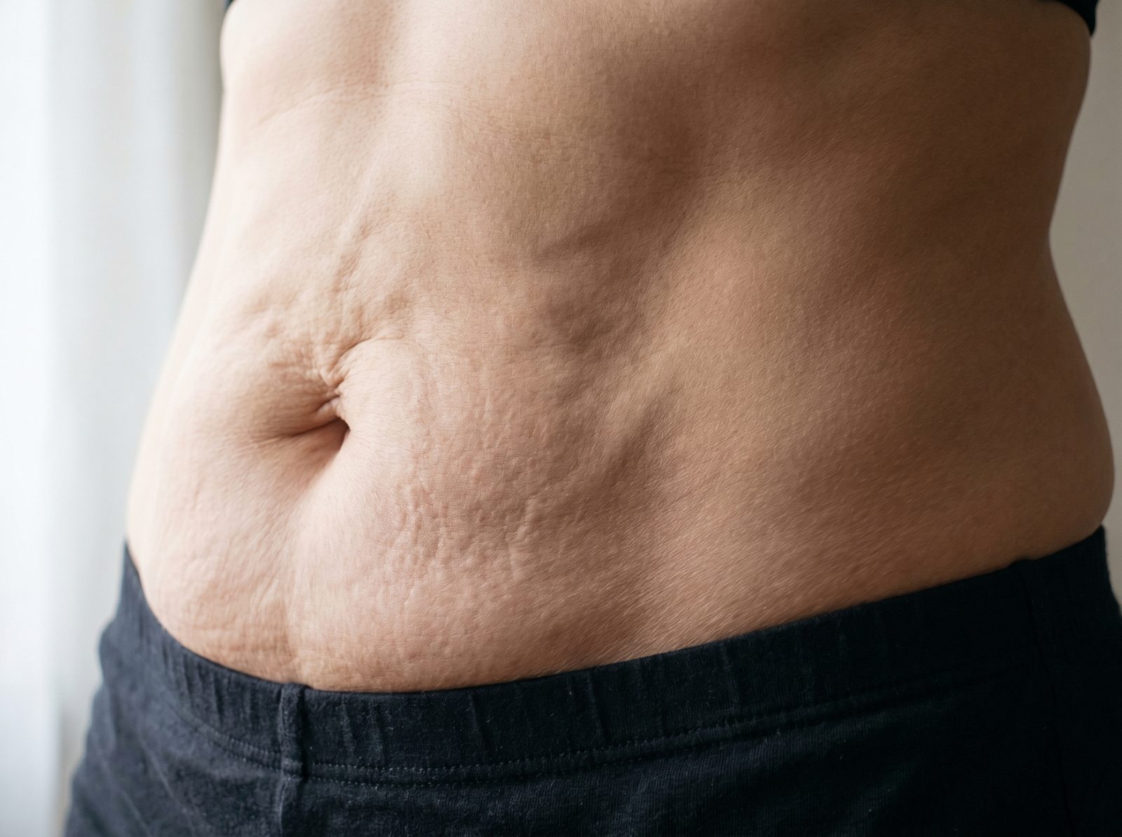 Loose, crepey skin on a woman's lower belly after rapid weight loss