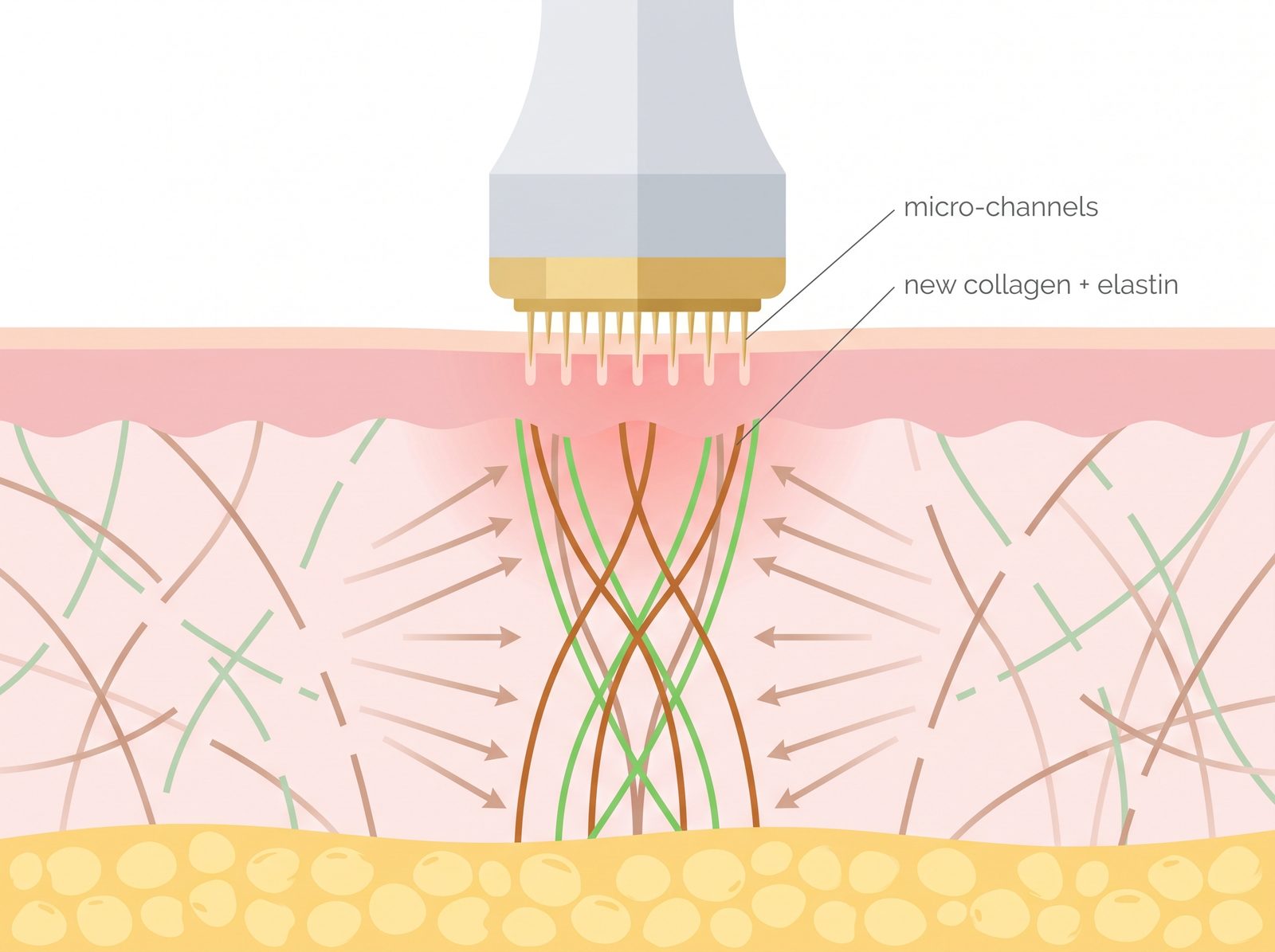 Microneedling cross-section: a stamp creates shallow micro-channels that trigger the body to rebuild new collagen and elastin in the dermis